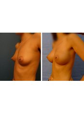 Breast Implants - Dr Garcia Paricio Personalized Plastic Surgery