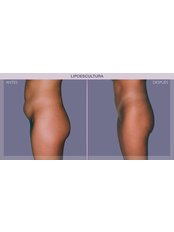 Liposuction - IM Clinic