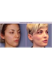FFS - Facial Feminization Surgery - IM Clinic