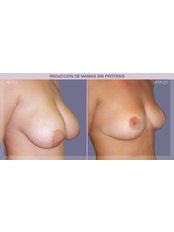 Breast Reduction - IM Clinic
