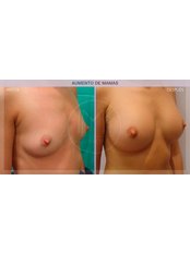 Breast Augmentation in Trans - IM Clinic