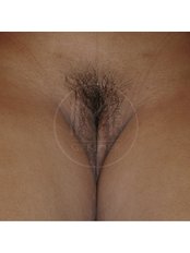 Penile inversion vaginoplasty - IM Clinic