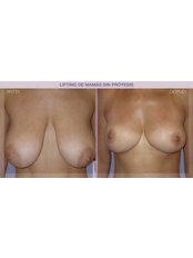 Breast Lift - IM Clinic