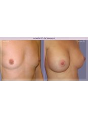 Breast Implants - IM Clinic