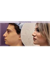 FFS - Facial Feminization Surgery - IM Clinic