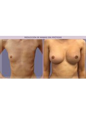 Breast Reconstruction - IM Clinic