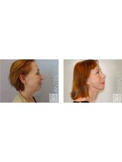 Facelift - IM Clinic