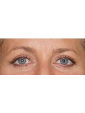 Eyelid Surgery - Ocean Clinic Madrid
