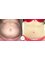 CBC Surgery Institute - Hospital Ceram - Before and after tummy tuck 