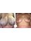 CBC Surgery Institute - Hospital Ceram - Before and after breast lift 