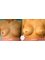 CBC Surgery Institute - Hospital Ceram - Before and after breast augmentation 