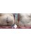 CBC Surgery Institute - Hospital Ceram - Before and after tummy tuck 