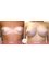 CBC Surgery Institute - Hospital Ceram - Before and after breast augmentation 