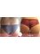 CBC Surgery Institute - Hospital Ceram - Before and after Brazilian butt lift 