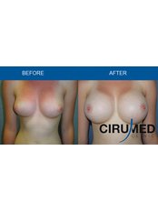 Breast Implants - Cirumed Clinic Marbella
