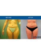 Body-Jet™ Liposuction - Cirumed Clinic Marbella