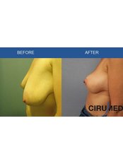 Breast Reduction - Cirumed Clinic Marbella
