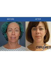 Facelift - Cirumed Clinic Marbella