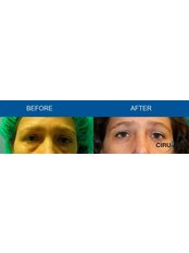 Eyelid surgery - Cirumed Clinic Marbella