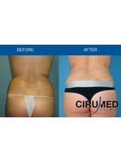 Body-Jet™ Liposuction - Cirumed Clinic Marbella