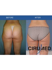 Laser Assisted Liposuction - Cirumed Clinic Marbella
