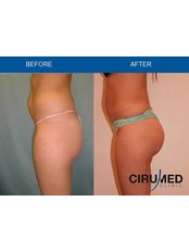 Butt Implants - Cirumed Clinic Marbella