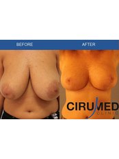 Breast Reduction - Cirumed Clinic Marbella