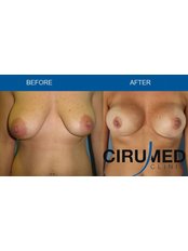 Nipple Reduction - Cirumed Clinic Marbella