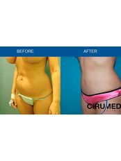 Tummy Tuck - Cirumed Clinic Marbella