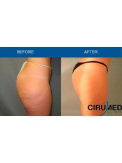 Liposuction - Cirumed Clinic Marbella