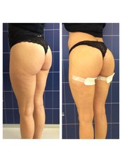 Gluteal Reshaping 3 - LaCLINIQUE of Switzerland - Lugano