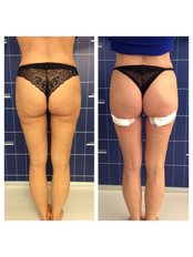 Gluteal Reshaping 1 - LaCLINIQUE of Switzerland - Lugano