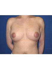 Fat Transfer - Breast - WISH Aesthetic Surgery Clinic