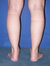 Calf Reduction - Selective nerve block - WISH Aesthetic Surgery Clinic