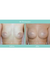 Breast Implants (free 1 night stay in VIP Room) - Dermaster Thailand