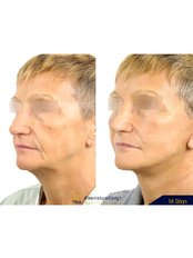 Mini Facelift - Dr. Chakarin Plastic Surgery