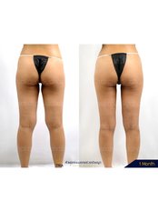 Thigh Liposuction - Dr. Chakarin Plastic Surgery