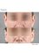 Dr. Chakarin Plastic Surgery - Otoplasty Surgery Case by Dr. Chakarin Suchakaro. It is a procedure that use to improve the appearance of his ears to make it more proportion to his face.  