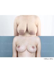 Breast Lift - Dr. Chakarin Plastic Surgery