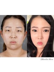 Double Eyelid Surgery - Dr. Chakarin Plastic Surgery