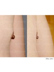 Nipple Reduction - Dr. Chakarin Plastic Surgery