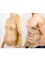 Dr. Chakarin Plastic Surgery - Six Pack Abs in an easiest way! Abdominal Etching Surgery performed by Dr. Chakarin. It is is a plastic surgery procedure that will make your abs look chiseled. 