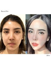 Buccal Fat Removal - Dr. Chakarin Plastic Surgery