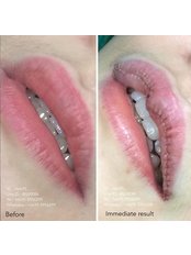 Lip Reduction - Dr. Chakarin Plastic Surgery