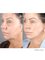 Dr. Chakarin Plastic Surgery - Facelift , Neck Lift and Liposuction lower chin 