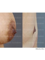 Areola Reduction - Dr. Chakarin Plastic Surgery