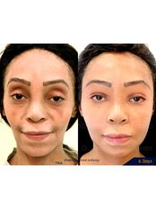 Facial Fat Transfer - Dr. Chakarin Plastic Surgery