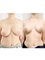 Dr. Chakarin Plastic Surgery - Breast Lift Surgery Case performed by Dr. Chakarin.  It is a procedure perform to raises the breasts by removing excess skin and tightening the surrounding tissue to reshape and support the new breast contour. 