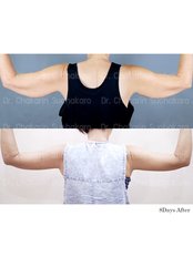 Arm Lift - Dr. Chakarin Plastic Surgery
