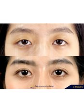 Eyelid Surgery - Dr. Chakarin Plastic Surgery